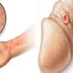 Illustration for article titled Penyakit Sipilis Menular Atau Tidakem/em